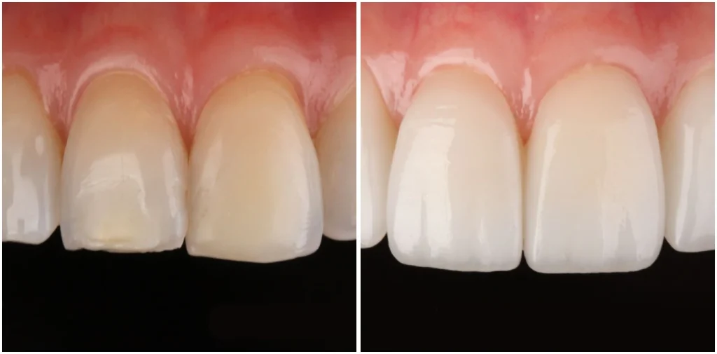 Anorexie, boulimie et santé bucco-dentaire : impact sur vos dents et gencives